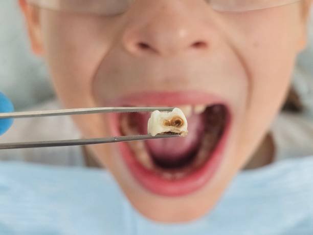 Best Emergency Wisdom Teeth Removal in Brandermill, VA